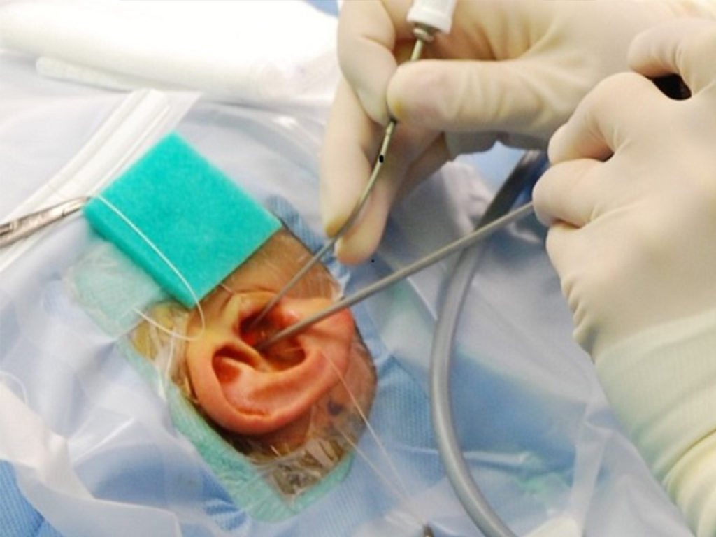 Ear Surgeries Aahan ENT Clinic Dr.Ajay Doiphode
