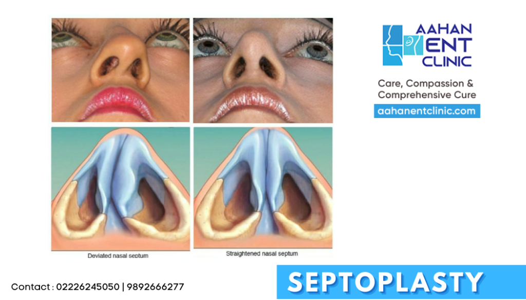 Deviated Nasal Septum & Septoplasty What you need to know Aahan ENT